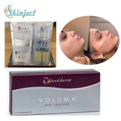 Hautfüller-Hyaluronsäure Juvederm Voluma für Gesichtsbacke Chin Contour