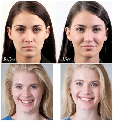 Hyaluronsäure-Gesichtsfüller Juvederms Voluma für Chin- und Backen-Vermehrung