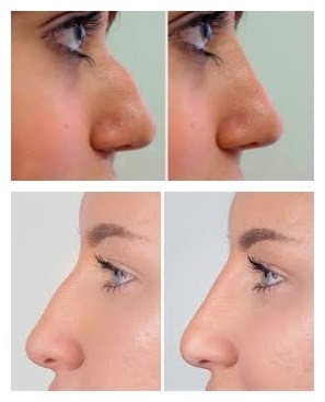 Hyaluronsäure-Gesichtsfüller Juvederms Voluma für Chin- und Backen-Vermehrung