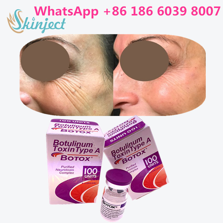 Botulinumgiftstoff Allergan  schreiben eine Verpackung der Phiolen-100units 1/des Kastens