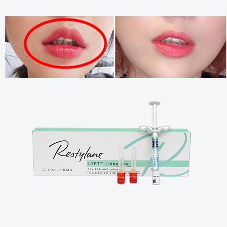 Vital  Perlane Cross Linked Dermal Filler Hyaluronsäure Lyft Hautfüllstoffe
