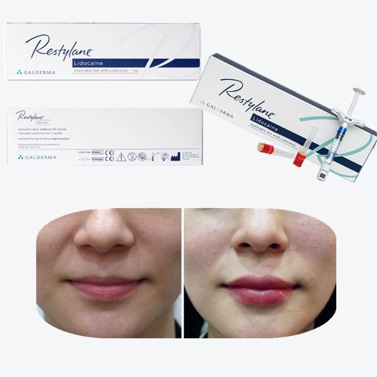 Cross-Linked Hyaluronsäure Hautfüllmittel zur Brustlippenvergrößerung