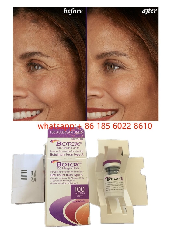 Schönheitsprodukte Allergan 100 Einheiten Botulinumtoxin  für Gesichtsfalten Hautfiller