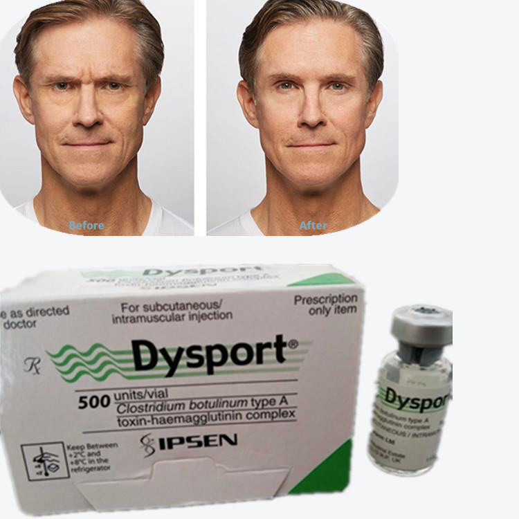 Botulinumtoxin Dysport 100IU Botulinumtoxin Typ A zur Abbau von Falten
