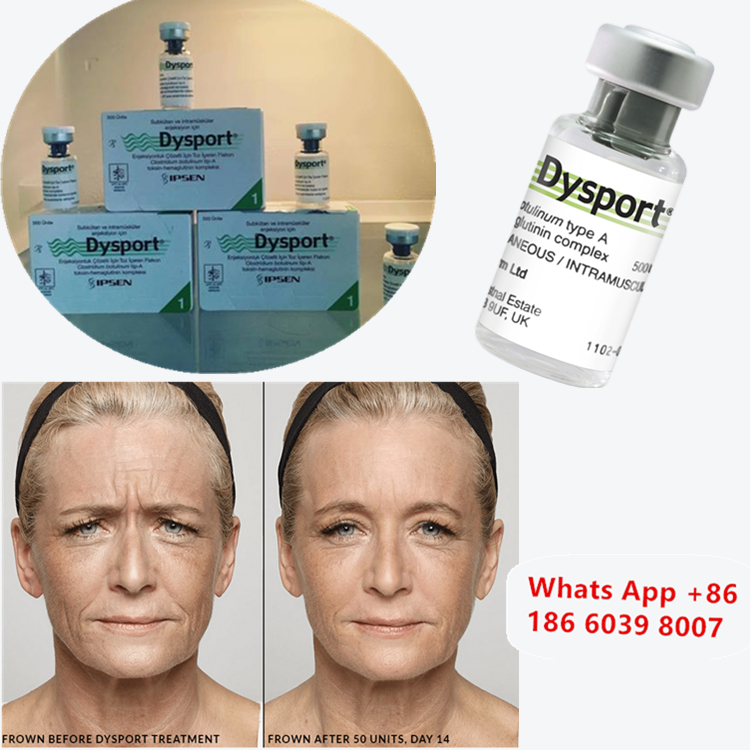 Dysport 500u Botulinumtoxin Typ A zur Wangevergrößerung