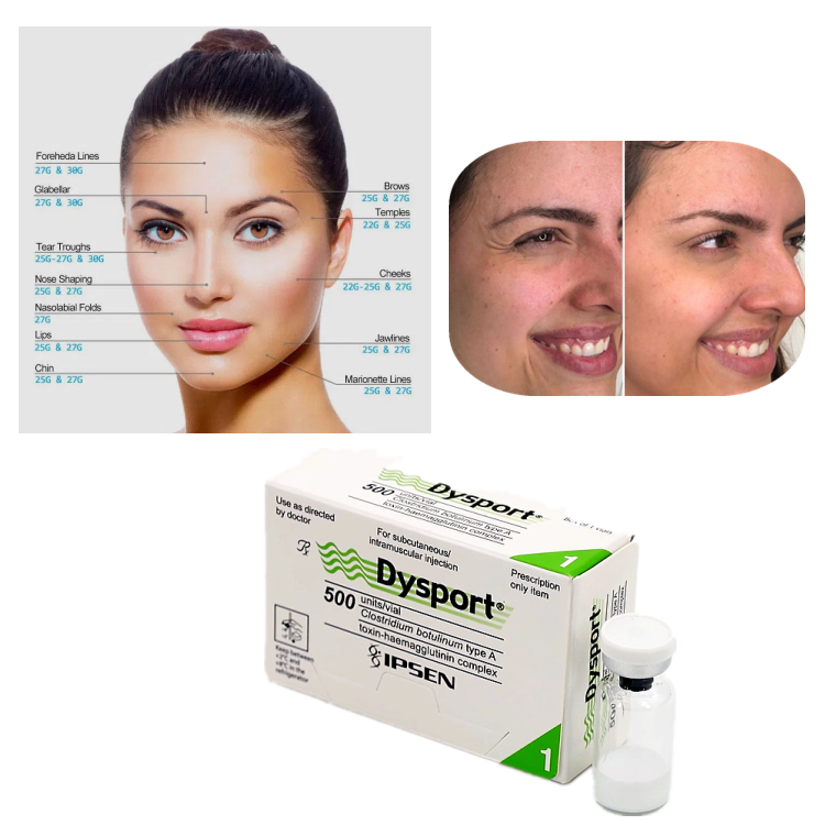 Dysport 500U Botulinumtoxin Typ A zur Faltenbehandlung