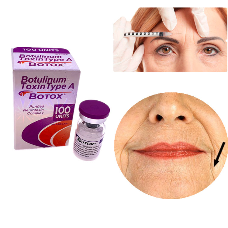 Allergan Botox 100IU Botulinumtoxin Typ A zur Entfernung von Gesichts- und Augenfalten