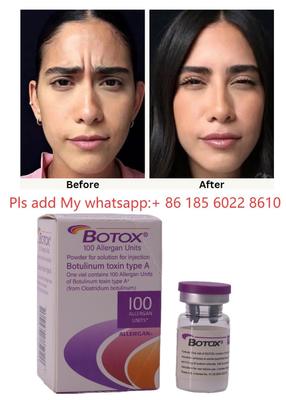 ALLERGAN Botox Injektion Botulinumtoxin Typ A