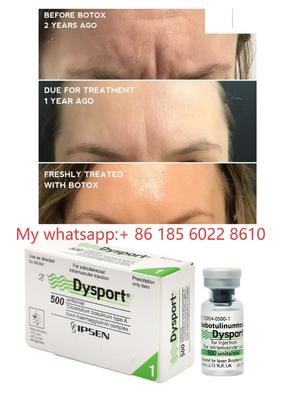 Dysport 500IE Injektionen Botulinumtoxin Allergan Botulax – Glättung feiner Linien und Falten